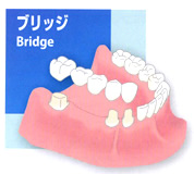 ブリッジ